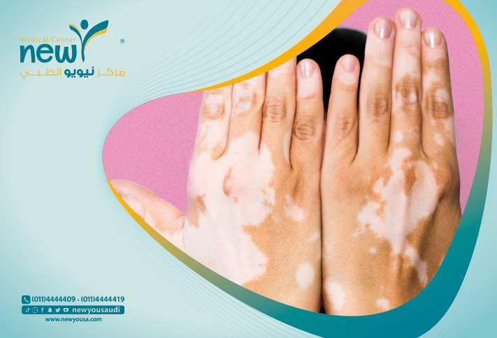 مرض البهاق تعرف عليه من خلال مركزنا الطبي في السعودية | نيويو