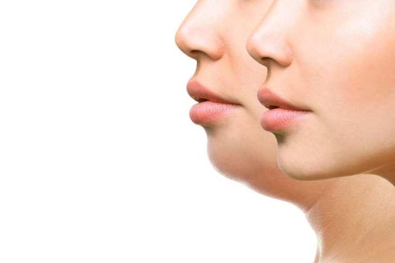علاج الذقن المزودج