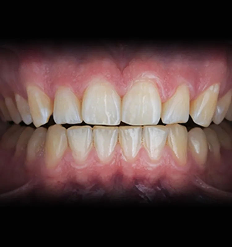 Before - الأسنان