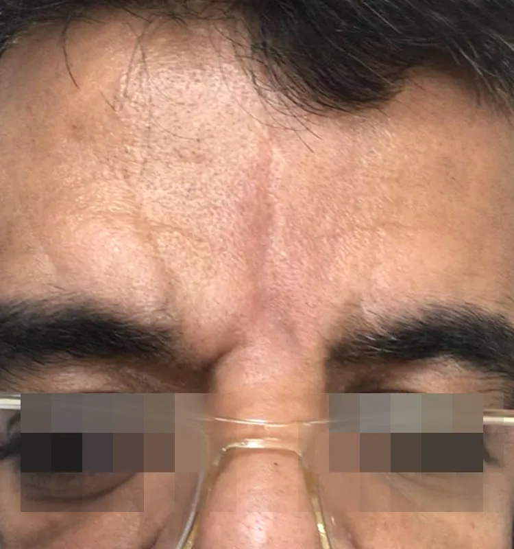 After - الجلدية