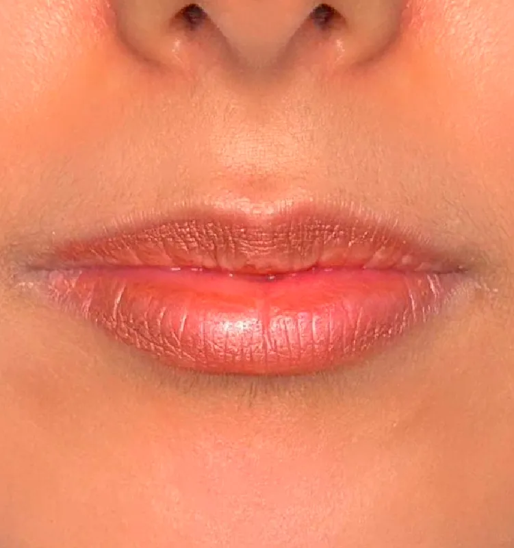 Before - الجلدية