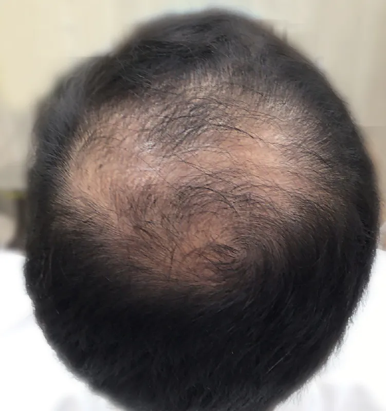 Before - الجلدية