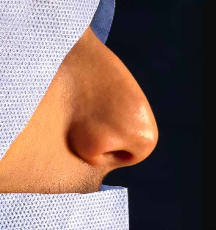 Before - التجميل الجراحي